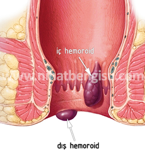 hemoroid oluşum şeması